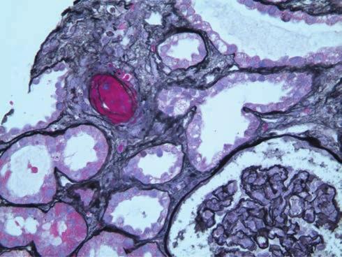 Tubulointerstital lesions ICDs Interstitial inflammation Tubulitis Arteriosclerosis TMA T cell Macrophage Figure 1