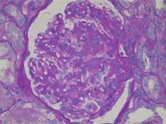 400). Class IV G exhibits global endocapillary and mesangial hypercellularity with infiltration of inflammatory cells