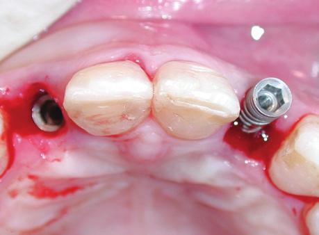 Previous augmentation procedures had been performed for 2.3% of the implant sites, 24.