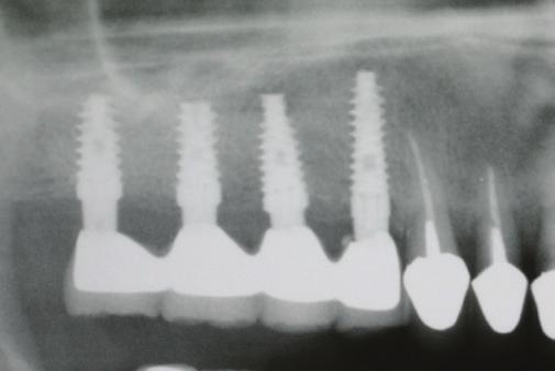 7 Implant distribution according to loading mode 600 500 529 400 300 200 100 0 Cemented bridge over implants 53 Full denture over bar 33 Cemented single crown 20 Cemented bridge over