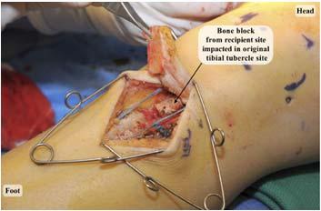 not to introduce valgus as plate approaches the metaphyseal flare What s different for the