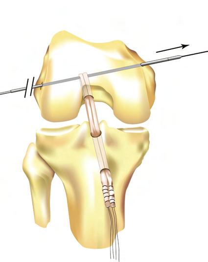 Pin. Next, the tamp is placed on the Stepped Guide Pin behind the Cross-Pin and then impacted until the Stryker Biosteon Cross-Pin is fully seated into the lateral femoral condyle (Figure 15).
