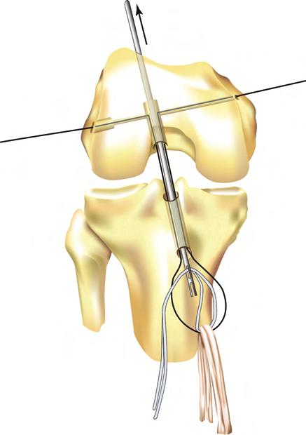 visible (Figure 11). It is important to keep the FLEXWIRE from twisting by using a hemostat on the strands of the wire after it has emerged from the tibia.