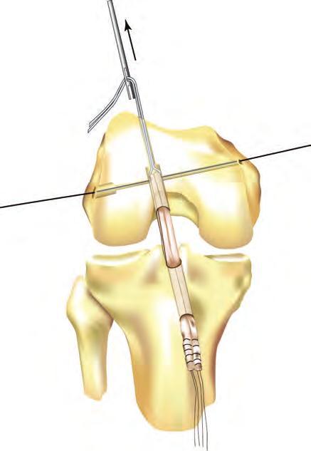 Femoral Tunnel Location and Preparation The best location on the femur for the ACL graft placement is approximately the one or two o clock position in a left knee or the 10 or 11 o clock position in