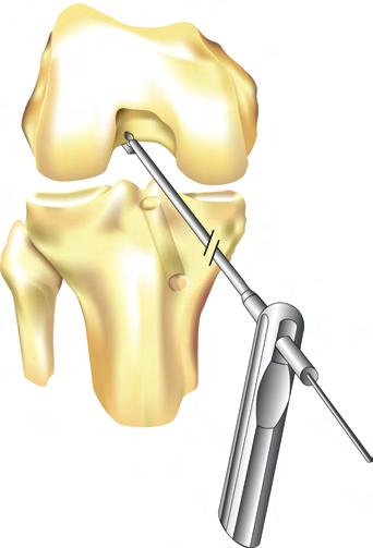 If the surgeon chooses he can use the Stryker Femoral Aimer to locate the exact position on the femur. The knee should be flexed beyond 90º to allow the guide to sit flush against the bone.