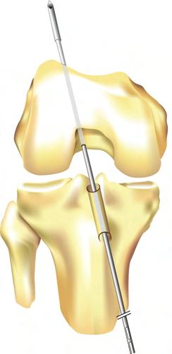 Once the surgeon has selected the appropriate position, the Stryker Forked Femoral Guide Pin is inserted through the tibial tunnel and drilled through the femur out the superior lateral musculature
