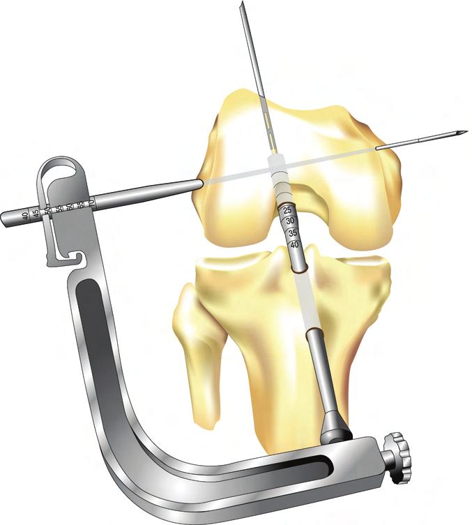 (NOTE: The center line of the Stryker Biosteon Cross-Pin is positioned 8mm from the top of the Transverse Femoral Index Guide, perpendicular to the axis.