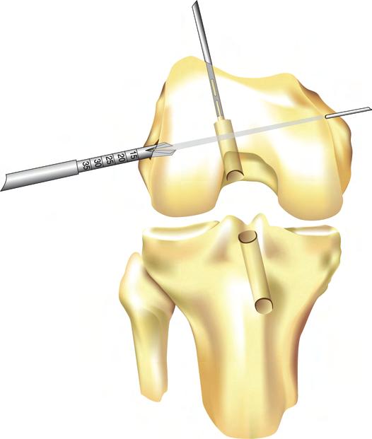 With the Transverse Drill Guide in a position that is parallel to the transcondylar axis or slightly angled anteriorly, the Transverse Guide Bullet is passed laterally until it contacts the lateral