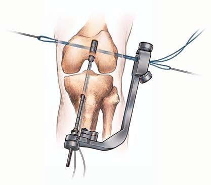 Guide Wire AXL Cannulated Drill Bit Figure 3 Figure 5 Figure 6 Figure 4 The distal tip of the insertion rod (on the properly prepared U-Guide ) is inserted trans-tibially into the femoral tunnel to