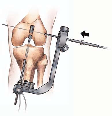 Insert the measuring bullet into the lateral arm of the U-Guide and rotate the guide so that the bullet touches the skin anterior to the lateral epicondyle, as per surgeon preference.