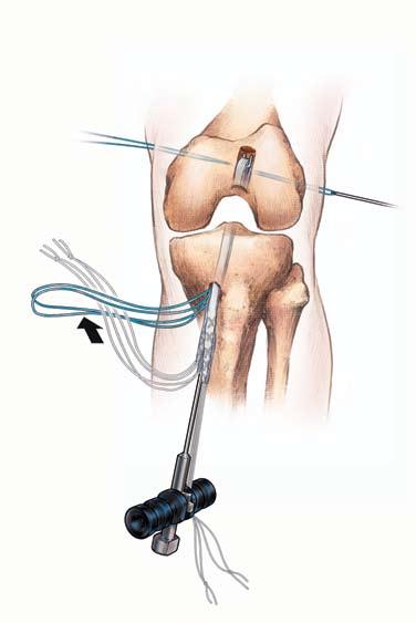 Figure 9 Figure 10 Figure 8 Remove the guide-wire from the sutures (on medial aspect of knee) and clamp both ends of the transverse pin alignment suture together with a Kelly or similar clamping