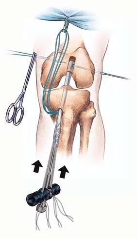 Remove the U-Guide from the knee pulling the transverse pin alignment suture (via the suture passed through the eyelets in the end of the insertion rod) out of the tibial tunnel (Figure 8).