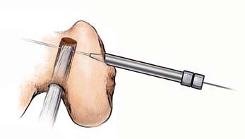 Pull the transverse pin alignment suture medially to advance the AXL implant passing pin into the lateral femoral condyle, below the loop in the