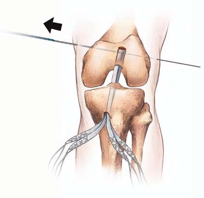Advance AXL obturator and sheath over the AXL implant passing pin through skin incision, through iliotibial band and down to the lateral cortex of