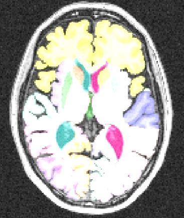 Web-appendix 5: Frontal lobe volumetric methodology The brain of each subject was parcellated into 83 non-overlapping regions (Hammers atlas - http://brain-development.