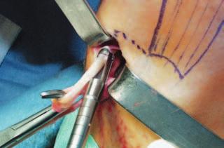 The more proximal fascial bands are released by blunt dissection with scissors, taking care to keep the tip of the scissors away from the tendon. 3-4.