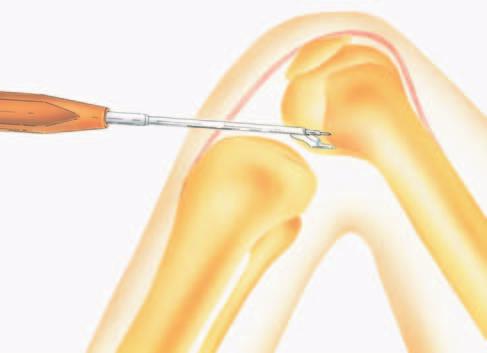 Tunnel placement ACL Reconstruction 10:00 h 4 mm 45 5 Placement of femoral tunnel K-wire placed at 10 or 2 o clock 4