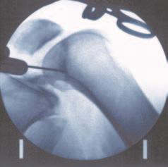 By drilling through the anteromedial portal, on the other hand, the centre of the anatomical point of insertion is