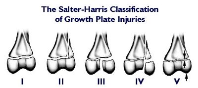 Salter Harris Classification System I. Separation II. Above III.