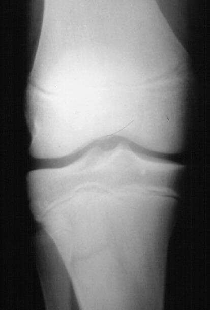 Salter I Fracture Distal Femur How would you
