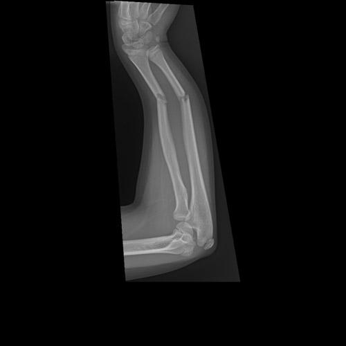 Radius and/or Ulna Fractures» This was an open fracture» Immediate Referral» Often will see Dark Blood
