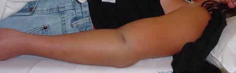 Supracondylar Fractures» Most common type is Fall on Outstretched Elbow» Marked