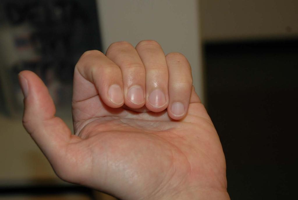 If the fingers do not li or they cross over it indicates angular or rotational