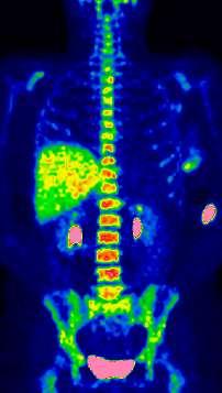 BREAST CANCER FLT PET shows different