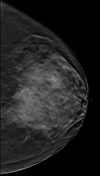 Are all tumours visible on DBT Palpable mass LT breast -