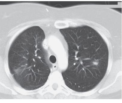 However Of all lung cancer 85% is attributable to smoking Most adenocarcinoma of the lung is attributable to