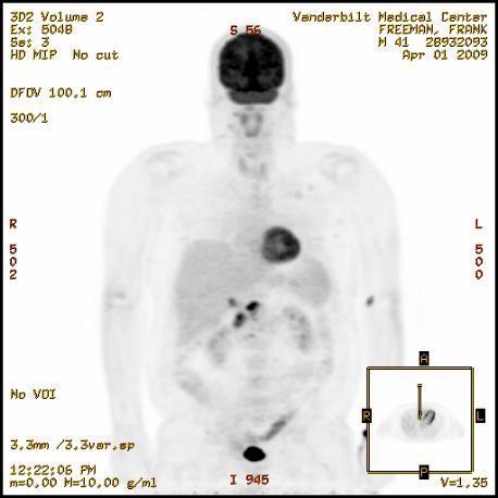 BRAF V600E Melanoma Patient PET Scan at Baseline
