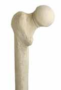 Hip Fracture Management Intracapsular fractures Total hip replacement (THR) can