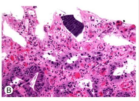 Kayexalate injury (stomach) erosive gastritis with angulated, basophilic crystal
