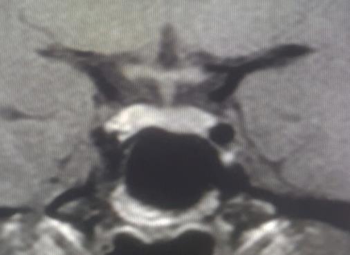 Figure 1:T1W, T2W MRI showing