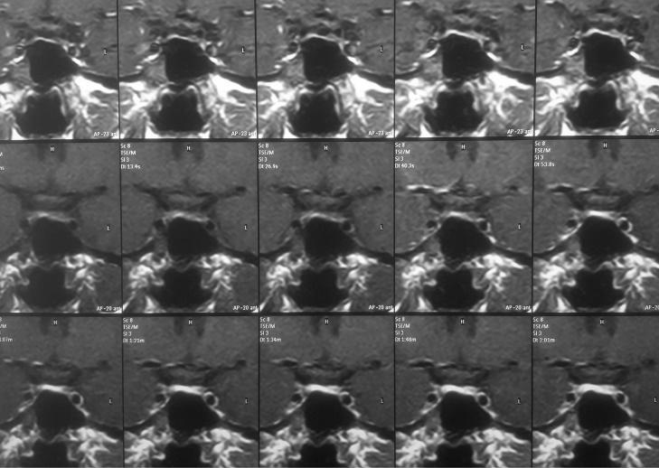 Figure 7: Dynamic Contrast MRI - gradual