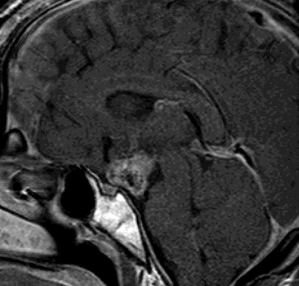 Sagittal enhanced T1-weighted image