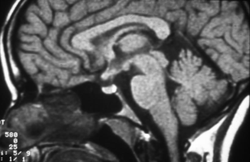 MRI of normal pituitary gland Parasellar area Hypothalamus