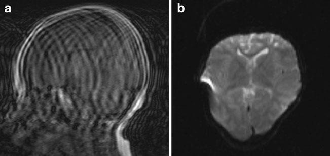 Childs Nerv Syst (2012) 28:1237 1241 1239 Fig. 2 Initial attempts to obtain T1 or T2 imaging on this noncooperative 3-year-old female resulted in a single, poor quality sagittal T1 image (a).