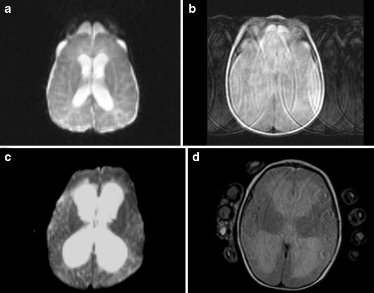 He has significant motion artifact on his axial T1 but good quality scanning during his axial diffusion scan (Fig. 1c, d). His ventricles are stable compared to previous nonfailure scans.