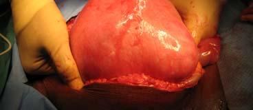 ? Presentation ADENOMYOSIS AUB-HMB Dysmenorrhea NOT a disease of the 4th & 5th decades of life Physical exam reveals enlarged globular uterus Diagnostic Evaluation Definitive diagnosis is by
