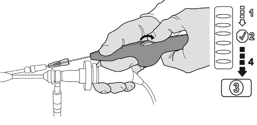 Withdrawal of the delivery catheter exposes the wound-down Essure insert.
