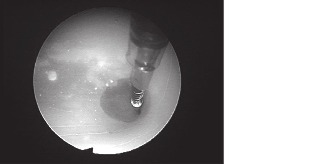 Repeat procedure in contralateral fallopian tube. A. Assessment of Insert After Deployment 1. The position of the deployed Essure insert will be assessed under hysteroscopic visualization.