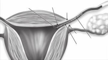 INDICATIONS FOR USE Essure is indicated for women who desire permanent birth control (female sterilization) by bilateral occlusion of the fallopian tubes. V.
