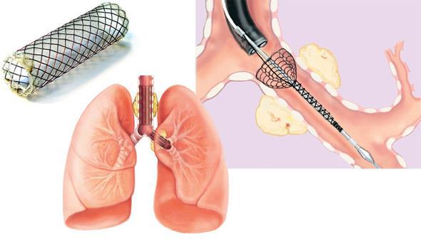 Interventional Pulmonology Program Rodrigo Burguete, MD Philip Ong, MD Maria Velez, MD Our specialists provide services that utilize