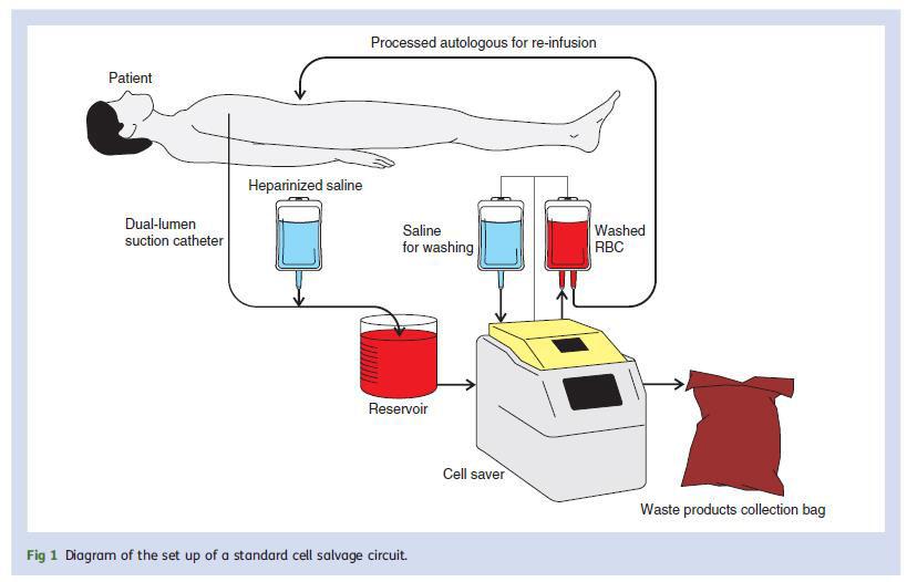 Autologous transfusion-massive hemorrhage Use of intra-operative red cell salvage is effective in reducing demand on allogeneic blood and provides a readily available red cell