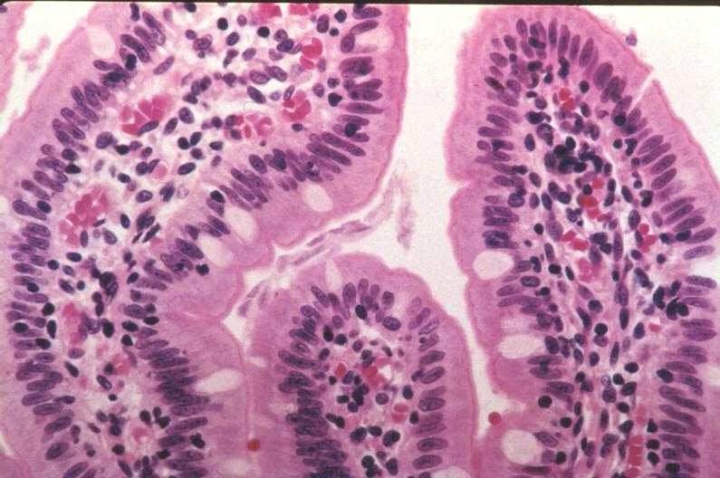 disease Lymphoma Mastocytosis Protein