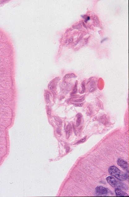 Lymphangiectasia Eosinophilic