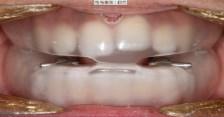 ncpap occlusal changes Not all Class IIs have OSA /not all OSAs are Class II Stay engaged in this rapidly changing and exciting field American Academy of Dental Sleep Medicine 2510 N Frontage Road,