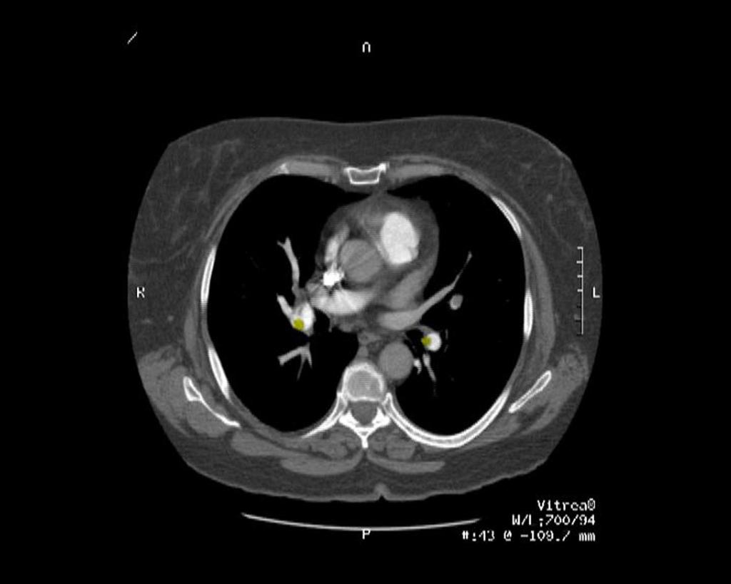 DIAGNOSIS OF PE BY CT PULMONARY ANGIOGRAPHY 13.