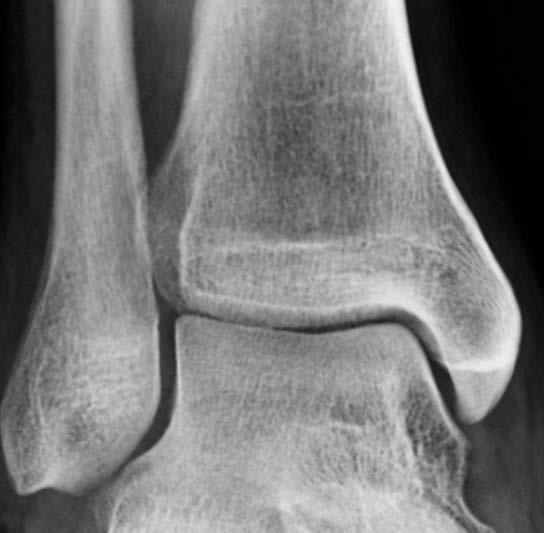 Xrays of ankle